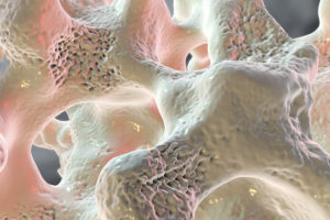 Spongy bone tissue affected by osteoporosis